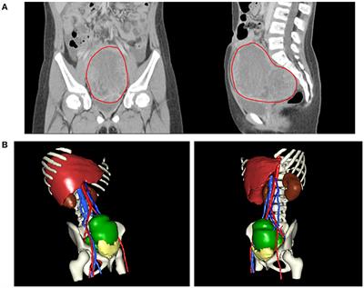 Yolk Sac Tumor in an Eight-Year-Old Girl: A Case Report and Literature Review